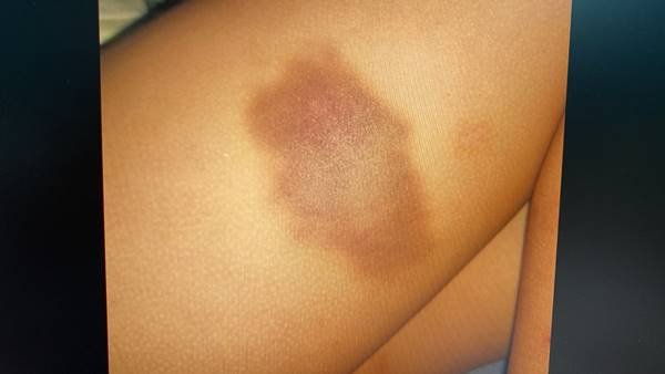 Fotografia colorida de hematoma no braço