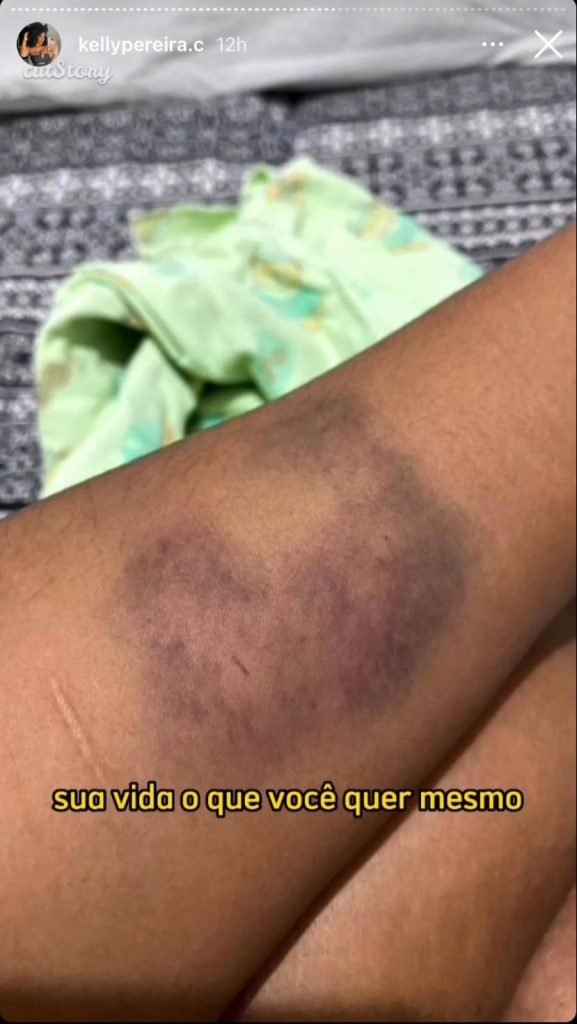 Foto colorida hematoma