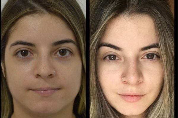 Gkay é comparada com personagem do Shrek após harmonização facial; confira