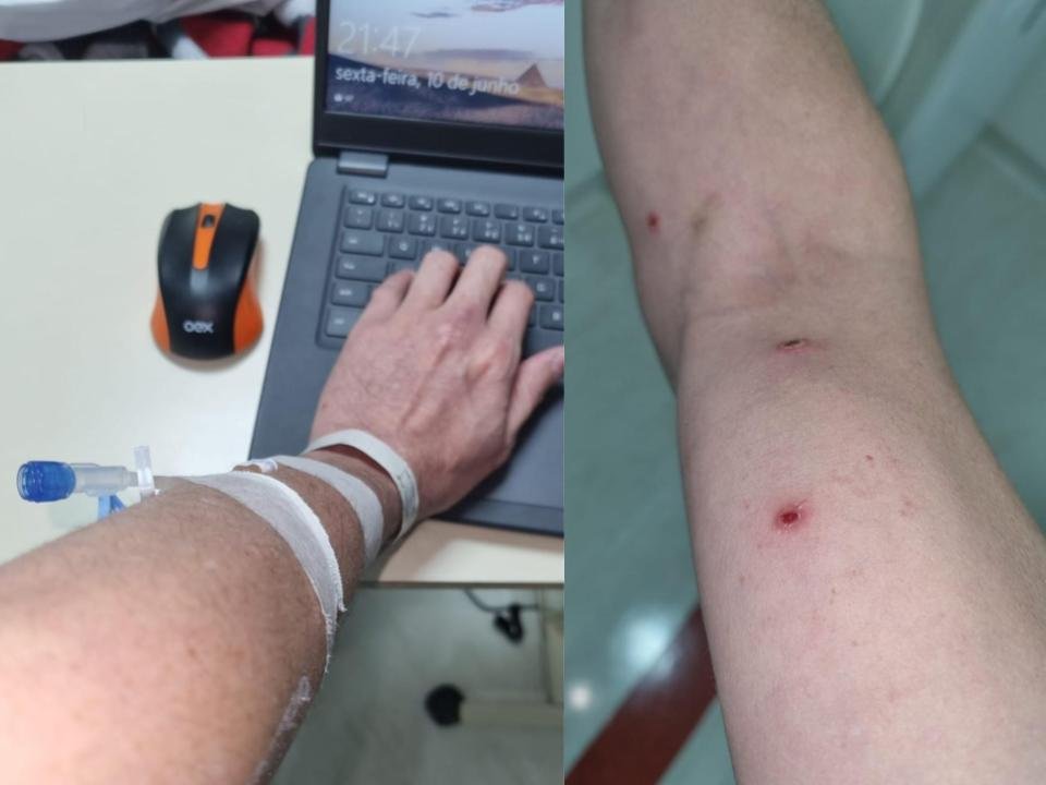 Primeiro brasileiro diagnosticado com varíola dos macacos