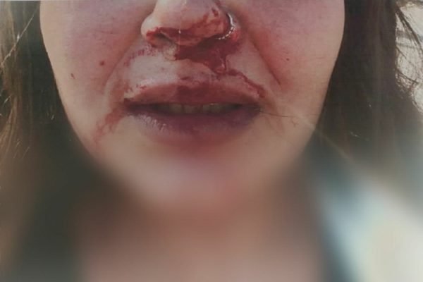 Jovem é agredida pelo ex em Aparecida de Goiânia, Goiás