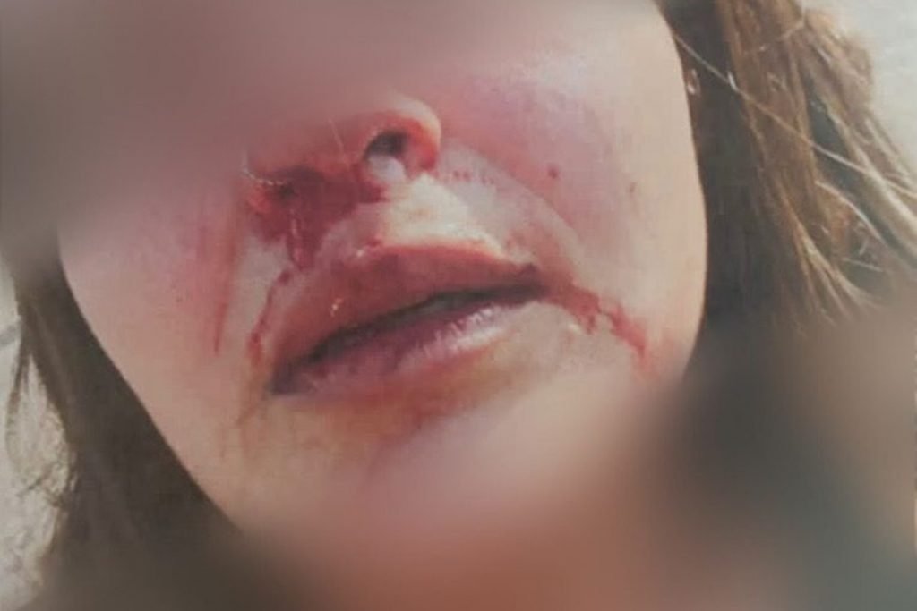 Jovem mostra sinais de agressão praticada pelo ex em Aparecida d Goiânia, Goiás