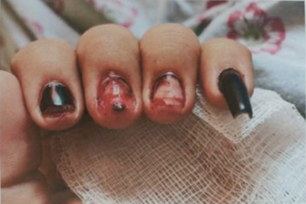 Jovem mostra unhas sangrando após ser agredida por ex em Aparecida de Goiânia, Goiás