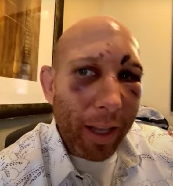Apesar de vencer duelo pelo UFC, Josh Emmett saiu com rosto bastante machucado