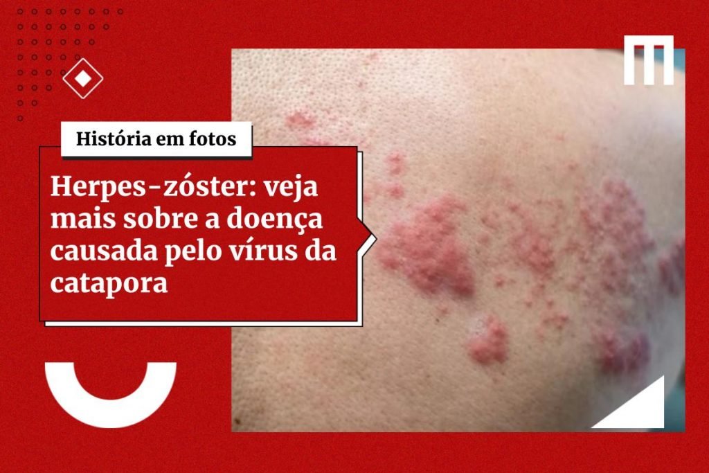 Damares é internada após paralisia facial causada por herpes zoster