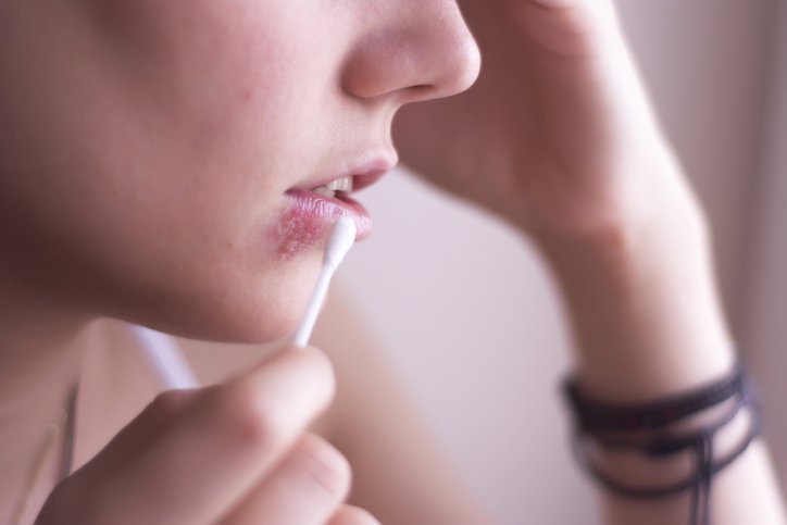 A person putting a cotton swab in a mouth sore - Metropolis