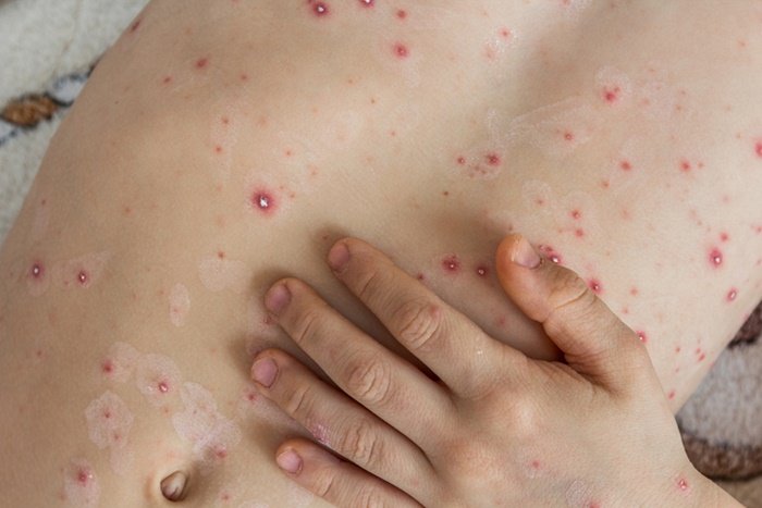 Damares é internada após paralisia facial causada por herpes zoster