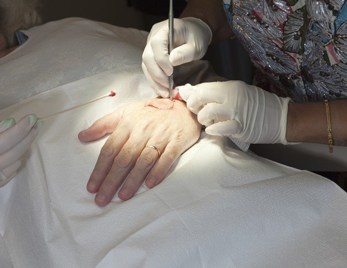 Person having surgery to remove skin cancer - Metropolis