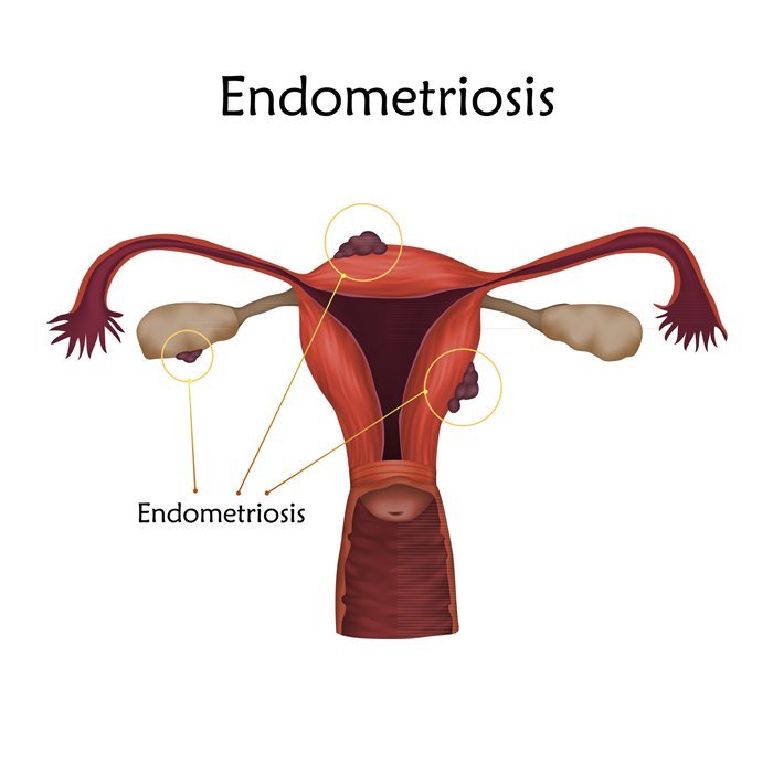 Ilustração de um útero com endometriose- Metrópoles