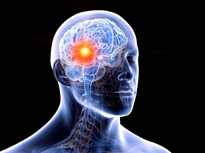 Ilustração pessoa com tumor cerebral- Metrópoles