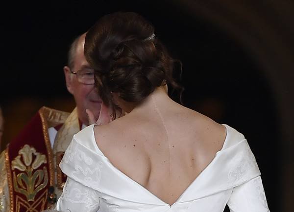 Princess Eugenie's Scoliosis Scar