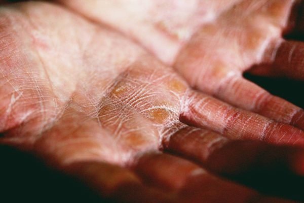 Foto colorida de mão com eczema