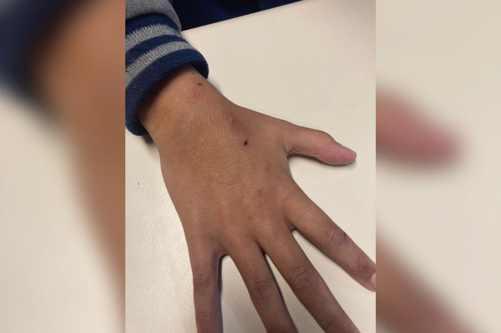 Criança queimada com frigideira foge de casa e pede ajuda a policiais- RJ 2