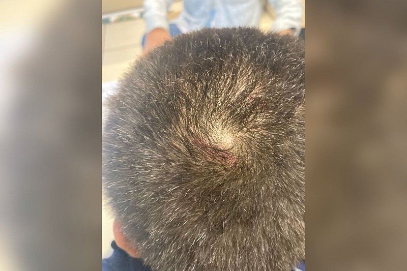 Criança queimada com frigideira foge de casa e pede ajuda a policiais- RJ 2