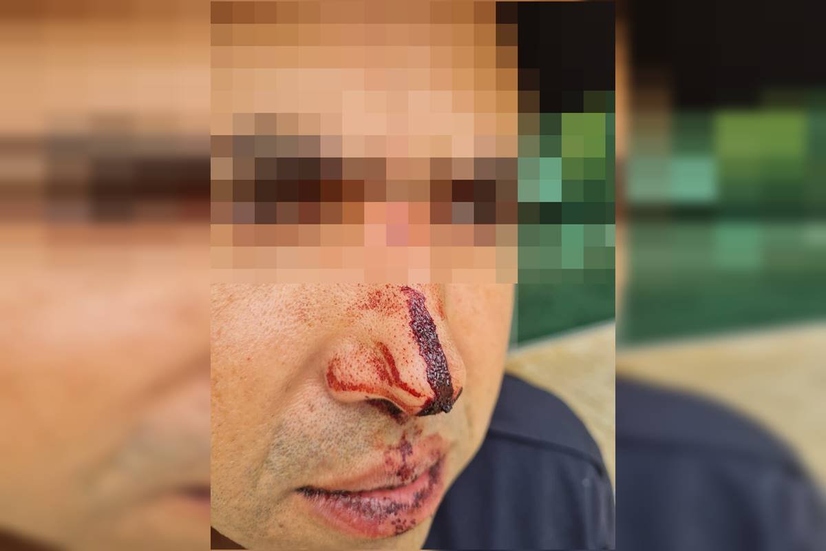 Homem com nariz coberto de sangue - Metrópoles
