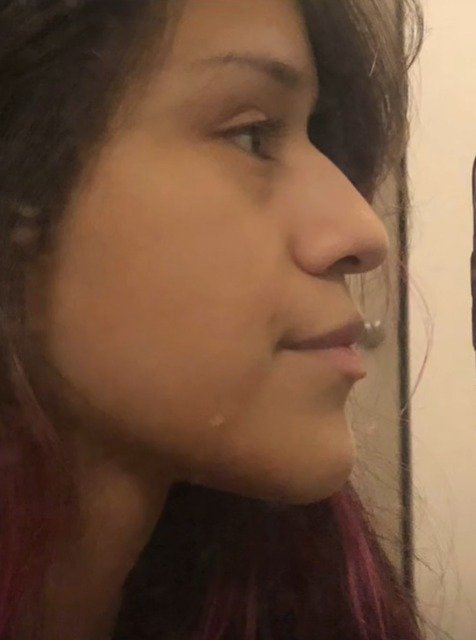 Revanche! Após ser traída, mulher faz ex pagar sua cirurgia plástica