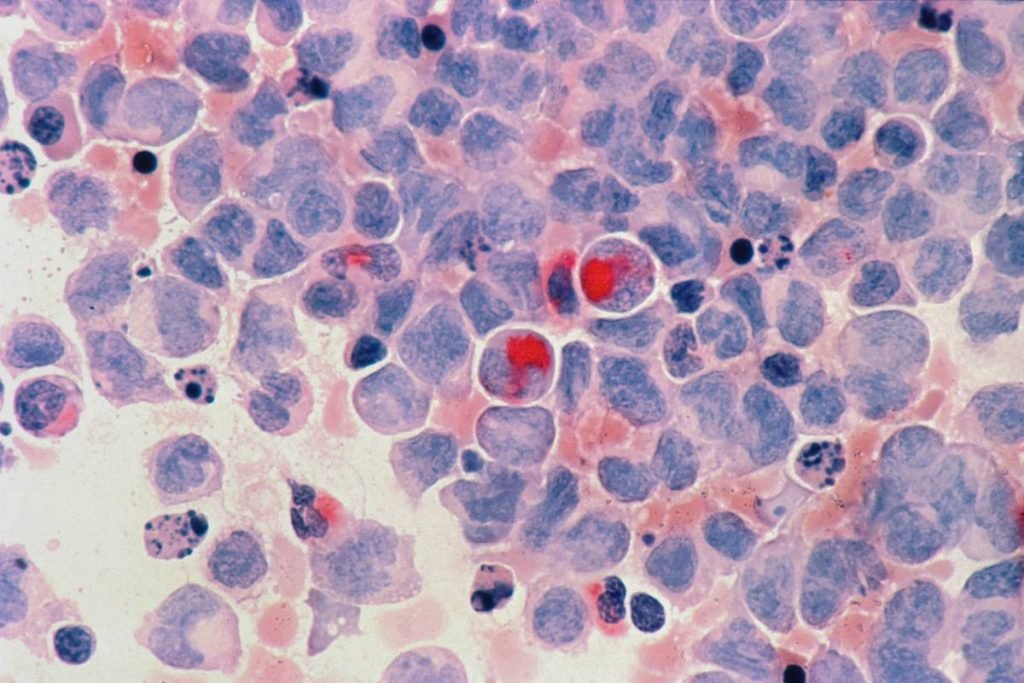 Foto colorida de um exame histológico de câncer - Metrópoles