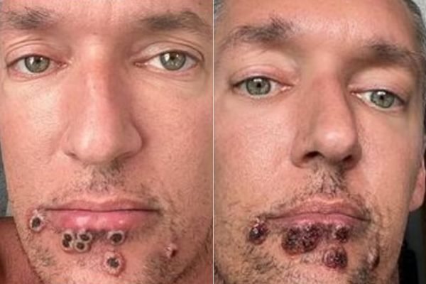 Monkeypox: ator pornô compartilha fotos de evolução das feridas | Metrópoles