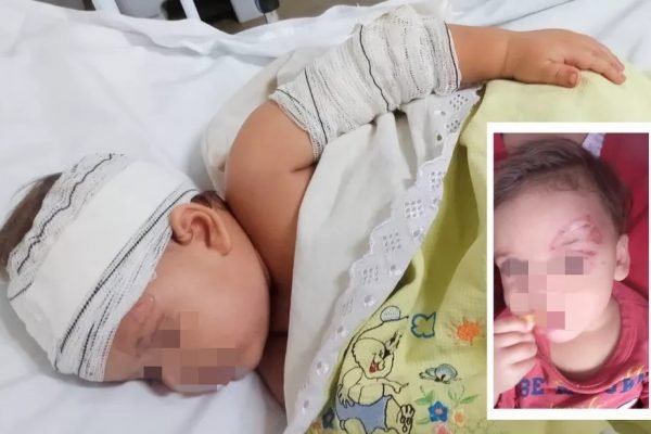 Bebê é queimado enquanto mãe cozinhava com álcool em Goiás
