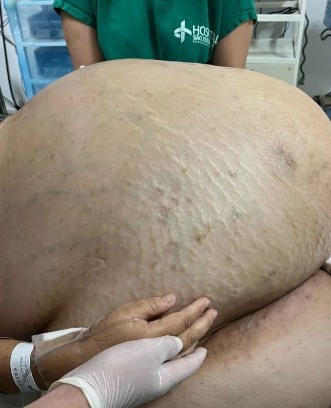 Tumor de 46kg é retirado de paciente no interior do RJ