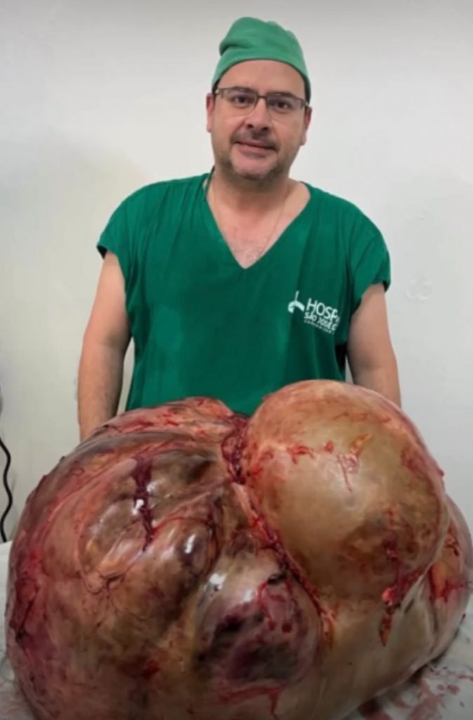Tumor de 46kg é retirado de paciente no interior do RJ