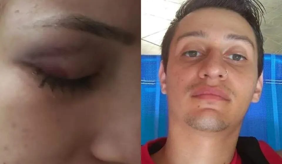 Fotos justapostas de olho fechado com escoreações de mulher agredida por ex-companheiro (esquerda) e homem acusado das agressões e foragido (direita) - Metrópoles