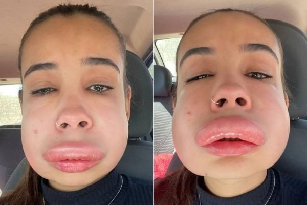 Preenchimento labial