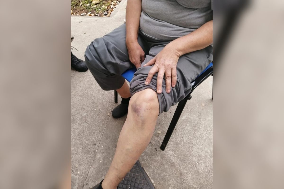 Foto de uma idosa com os joelhos machucados