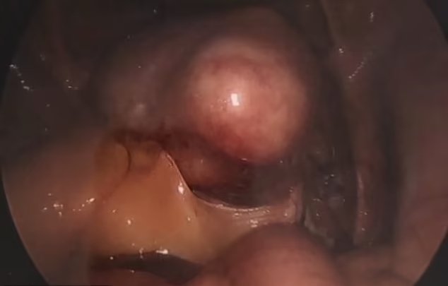 imagem de cistos do tamanho de toranjas no útero