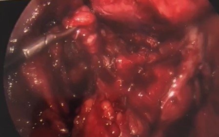 imagem de laparoscopia de útero com endometriose