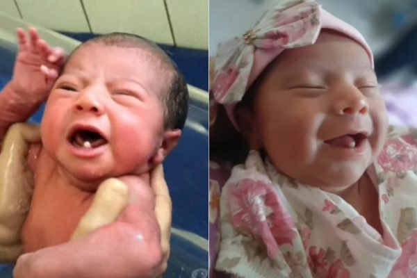 Bebê nasce com dois dentes e viraliza nas redes sociais