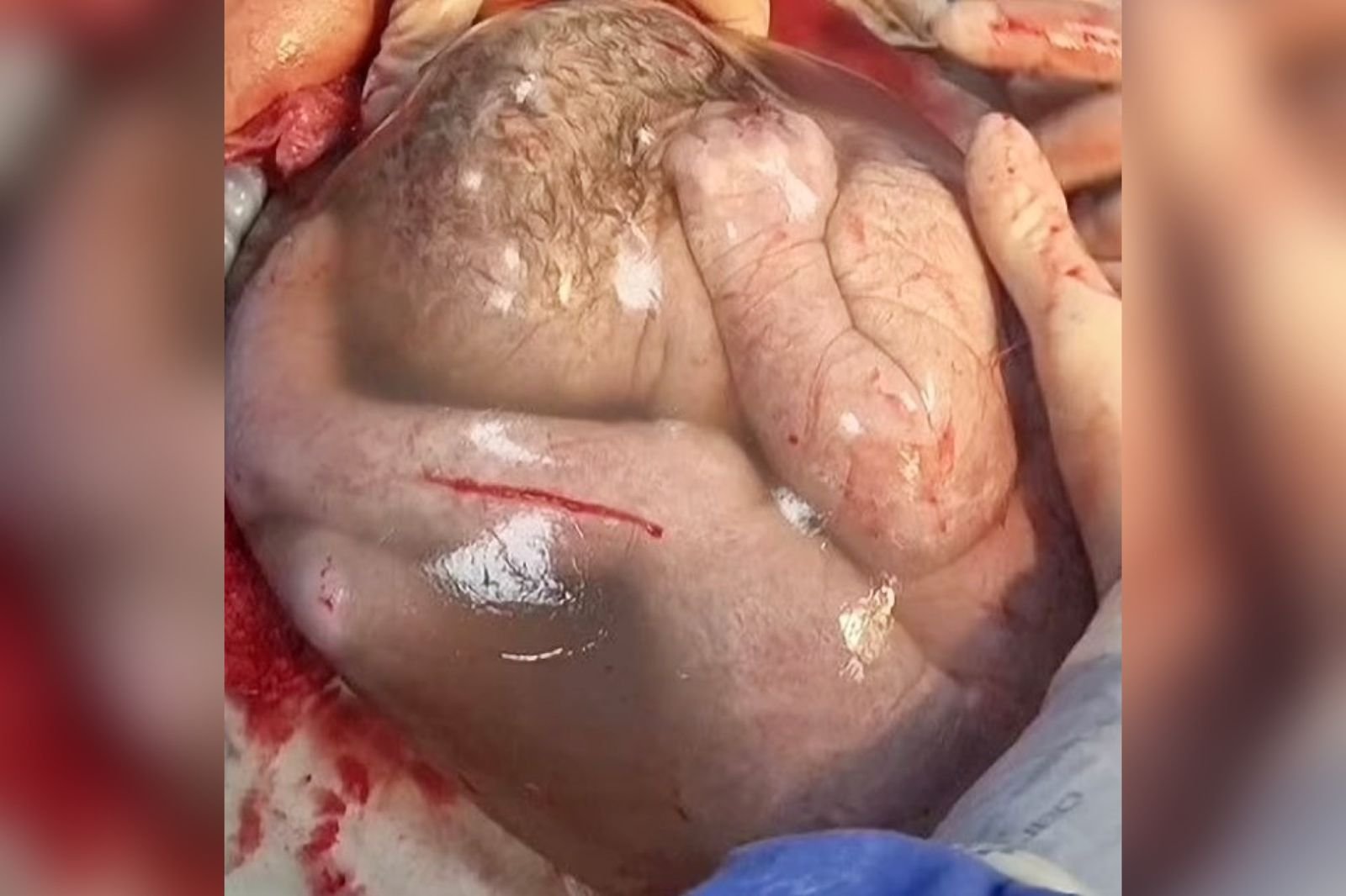 imagem de bebê rescém-nascida ainda dentro da bolsa amniótica da mãe