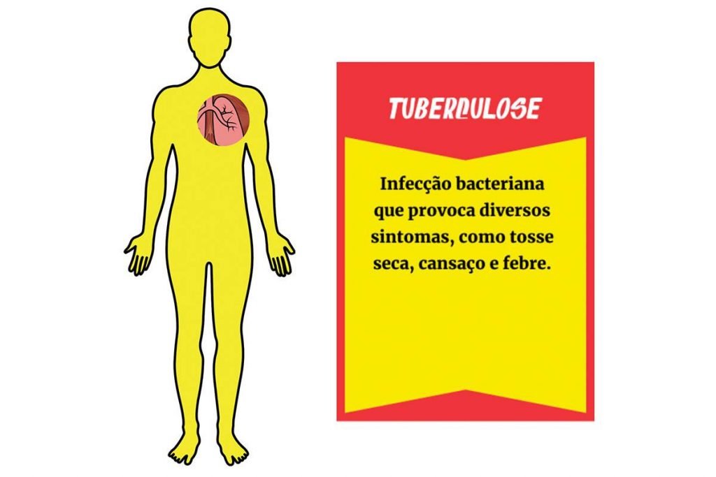 Arte mostra áreas do corpo humano, em destaque, afetadas pela doença tuberculose, que pode ser contraída ao ingerir carne contaminada. Ao lado, banner com explicação sobre a bacteriose - Metrópoles
