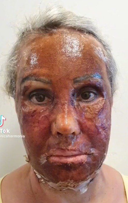 Peeling de fenol - tratamento - pele
