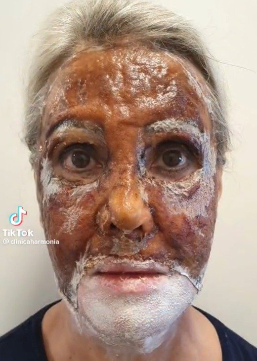 Peeling de fenol - tratamento - pele