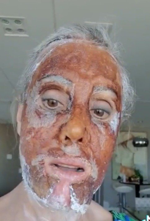 Peeling de fenol - tratamento - pele