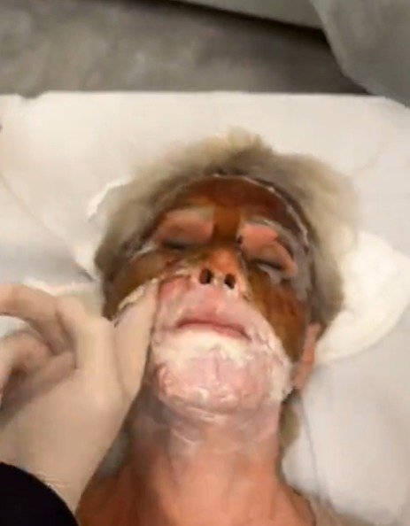 Peeling de fenol - tratamento - pele