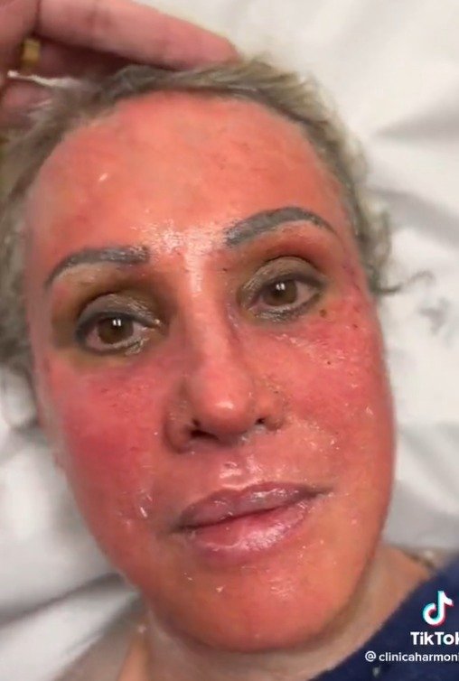 Peeling de fenol - tratamento - pele