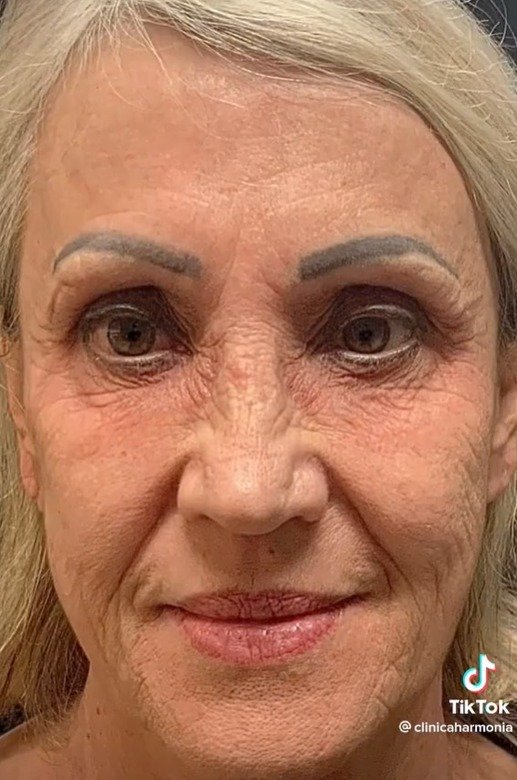 Peeling de fenol - tratamento - pele