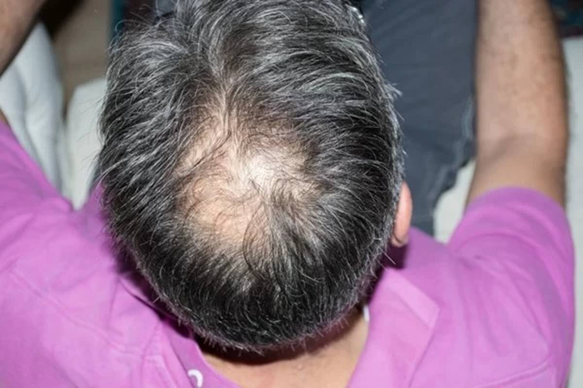 Calvão de cria': corte de cabelo para ficar calvo viraliza entre