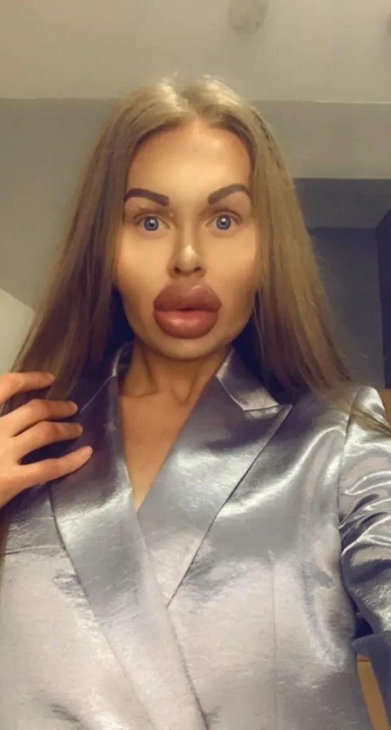 Homem com diversos preenchimentos faciais - Metrópoles