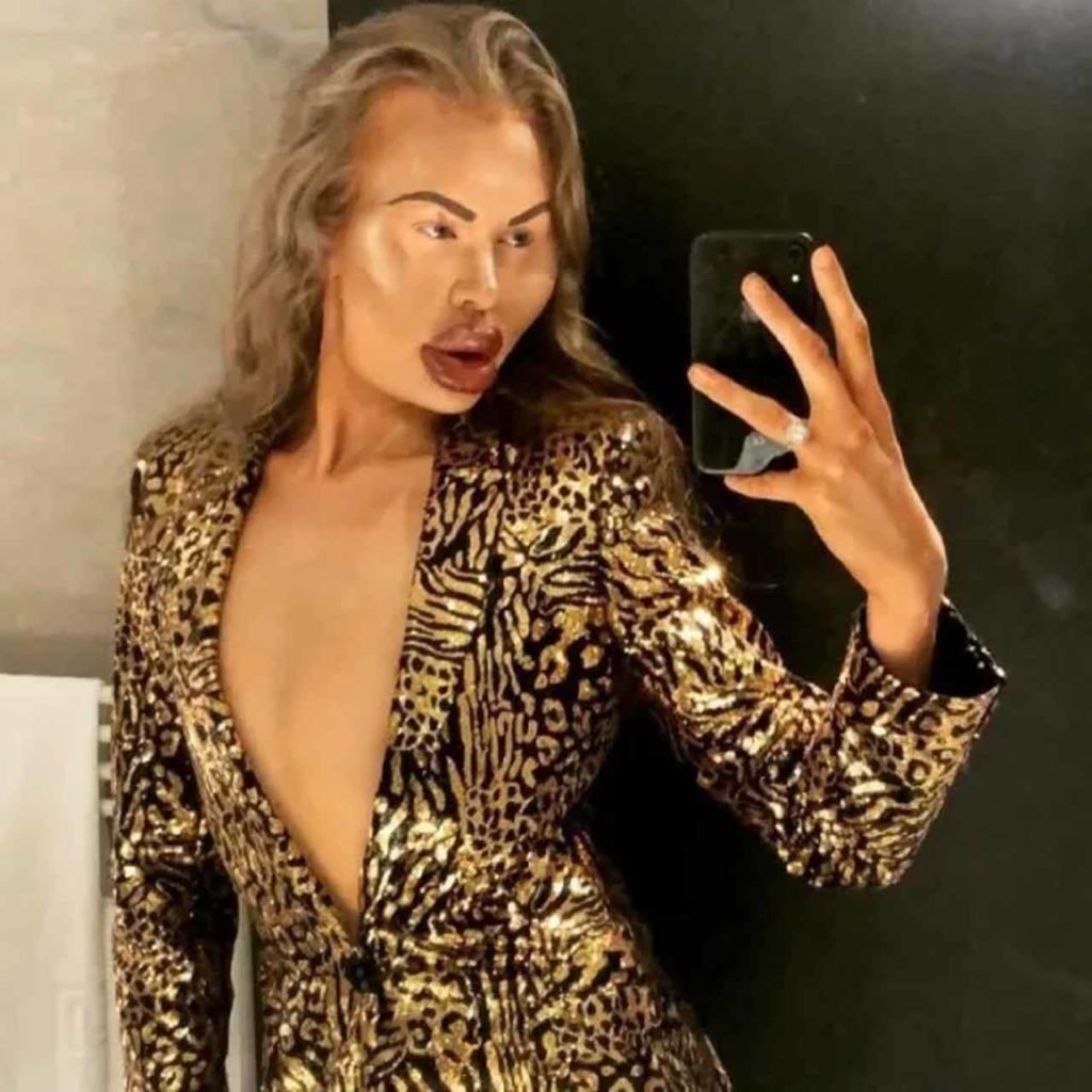 Homem com diversos preenchimentos faciais - Metrópoles