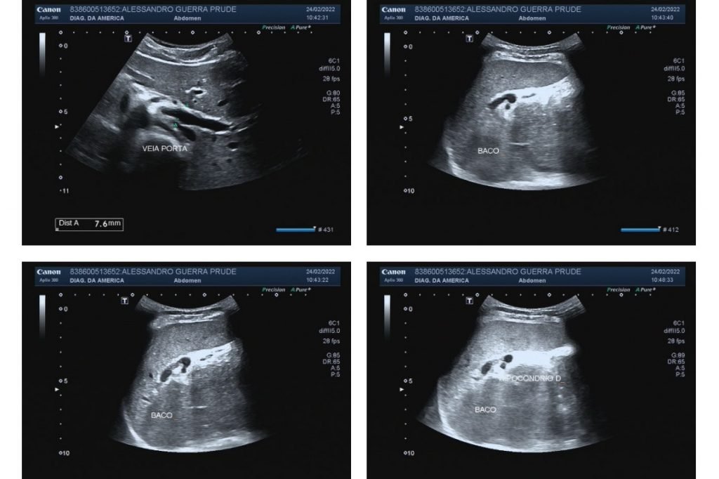 Imagens de ultrassonografia mostram baço em lado invertido - Metrópoles