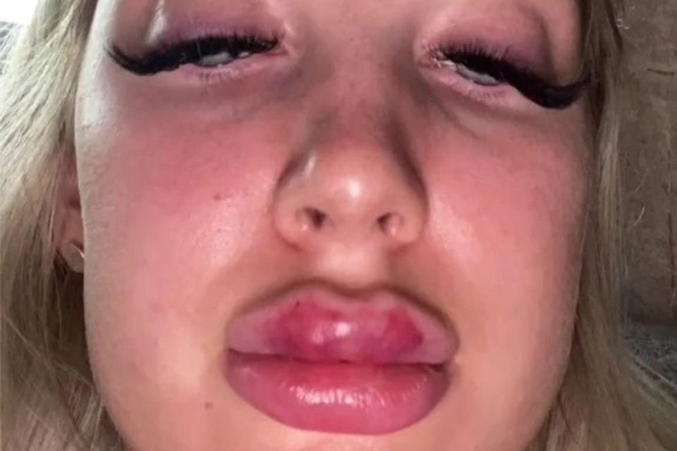 Mulher tirando foto bem próxima do rosto, mostrando os lábios inchados e com erupções vermelhas