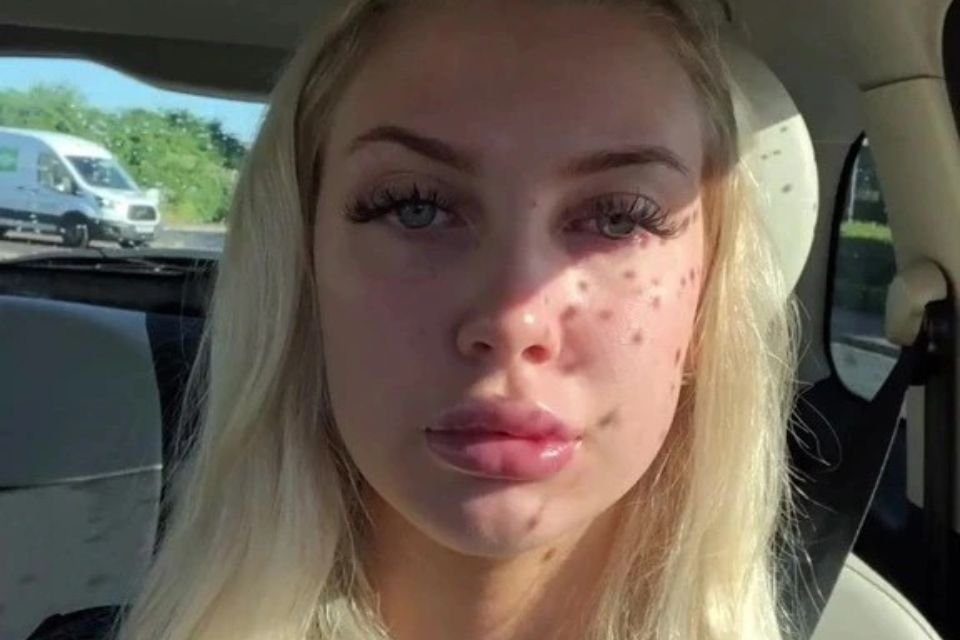 Mulher branca e loira mostrando os lábios inchados