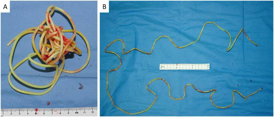 imagem de corda de polivinil removida de dentro da bexiga do paciente. Ela estava enrolada no corpo do homem
