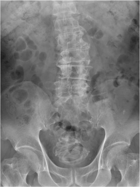 radiografia de corda de pular na região pélvica do paciente