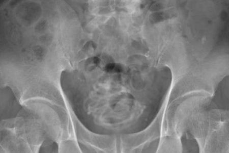 exame de imagem do objeto dentro do corpo do paciente