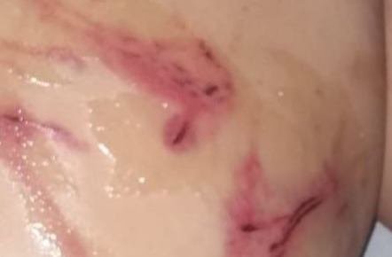 imagem colorida de ferimentos causados por galho de jabuticabeira