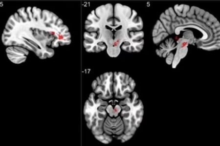 exames de imagem de cérebro de pacientes com covid longa. Em vermelho há placas acumuladas